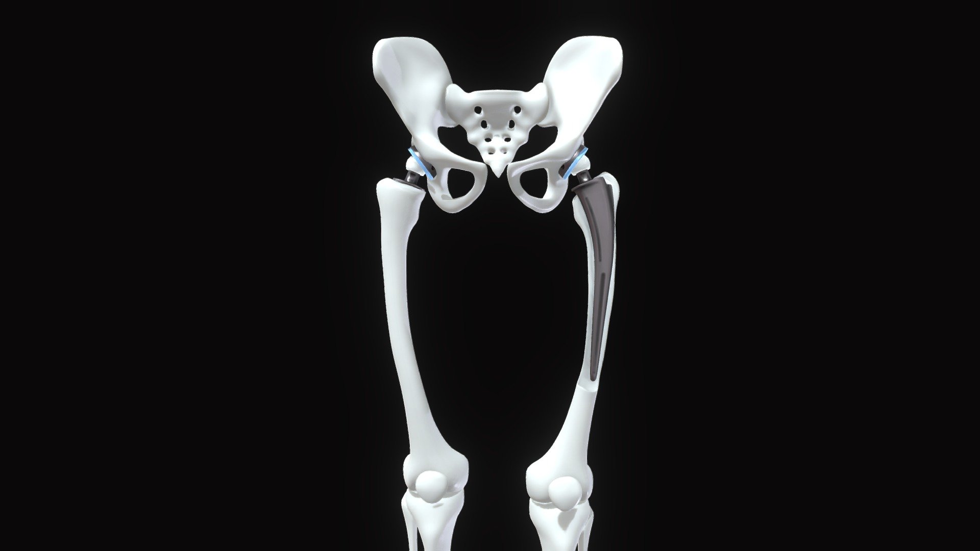 Originally modeled in Cinema 4D R 21


Maps for Hip replacement implant installed in the pelvis bone
2 object :
Implant 
- BaseColor
- Metallic
- Roughness
- Normal
- AO
Legs
- BaseColor
- Metallic
- Roughness
- Normal


SCALE:
- Model at world center and real scale:
       Metric in centimeter
       1 unit = 1 centimeter


Texture resolution 4096x4096
Texture format PNG


Poly Count :
Polygon Count - 91645
Vertex Count - 89825 - Hip Replacement Implant Bone Legs - Buy Royalty Free 3D model by zames1992 3d model