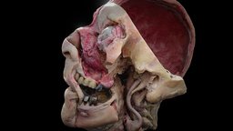 Maxillary Sinus & Lacrimal gland artery, external, carotid