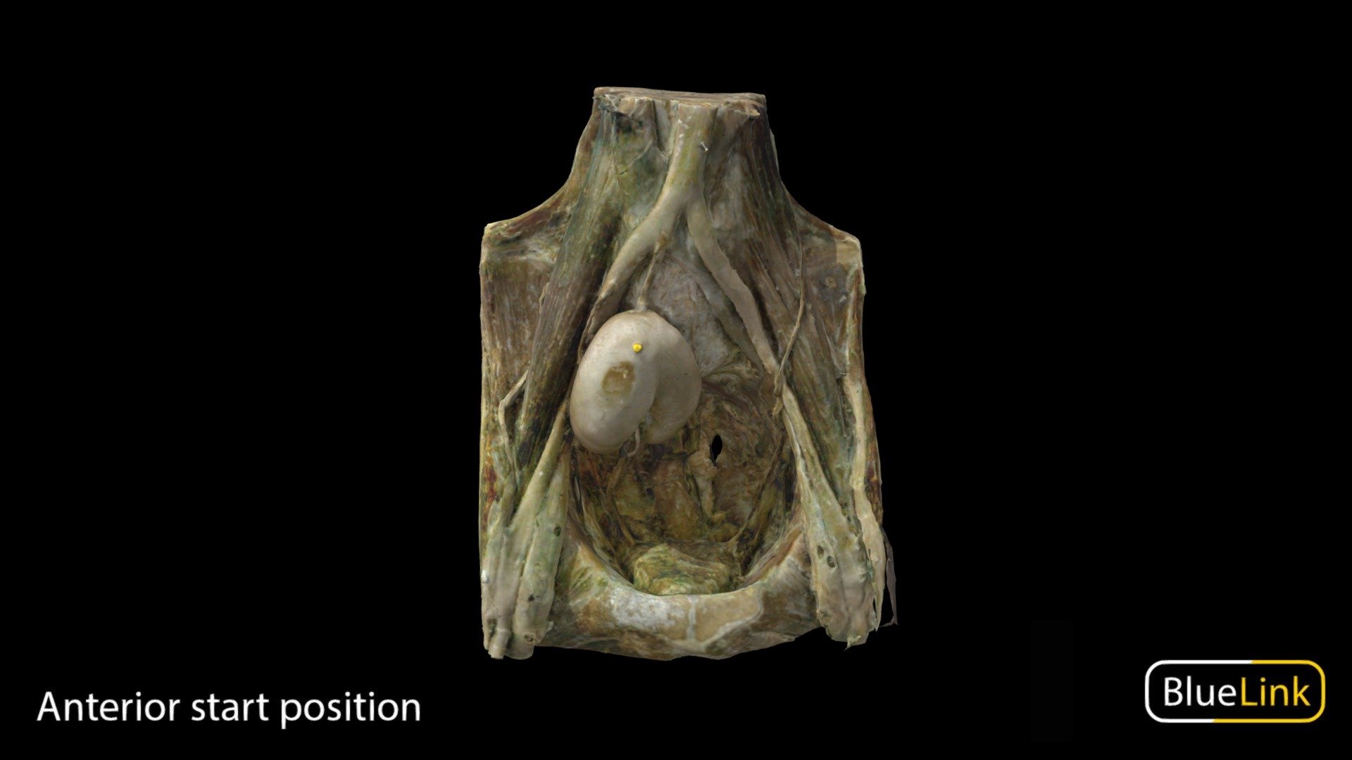 3D scan of an Ectopic Kidney

Captured with Einscan Pro

Captured and edited by: Will Gribbin

Copyright2019 BK Alsup &amp; GM Fox

ID 90000-P01 - Ectopic Kidney - 3D model by Bluelink Anatomy - University of Michigan (@bluelinkanatomy) 3d model