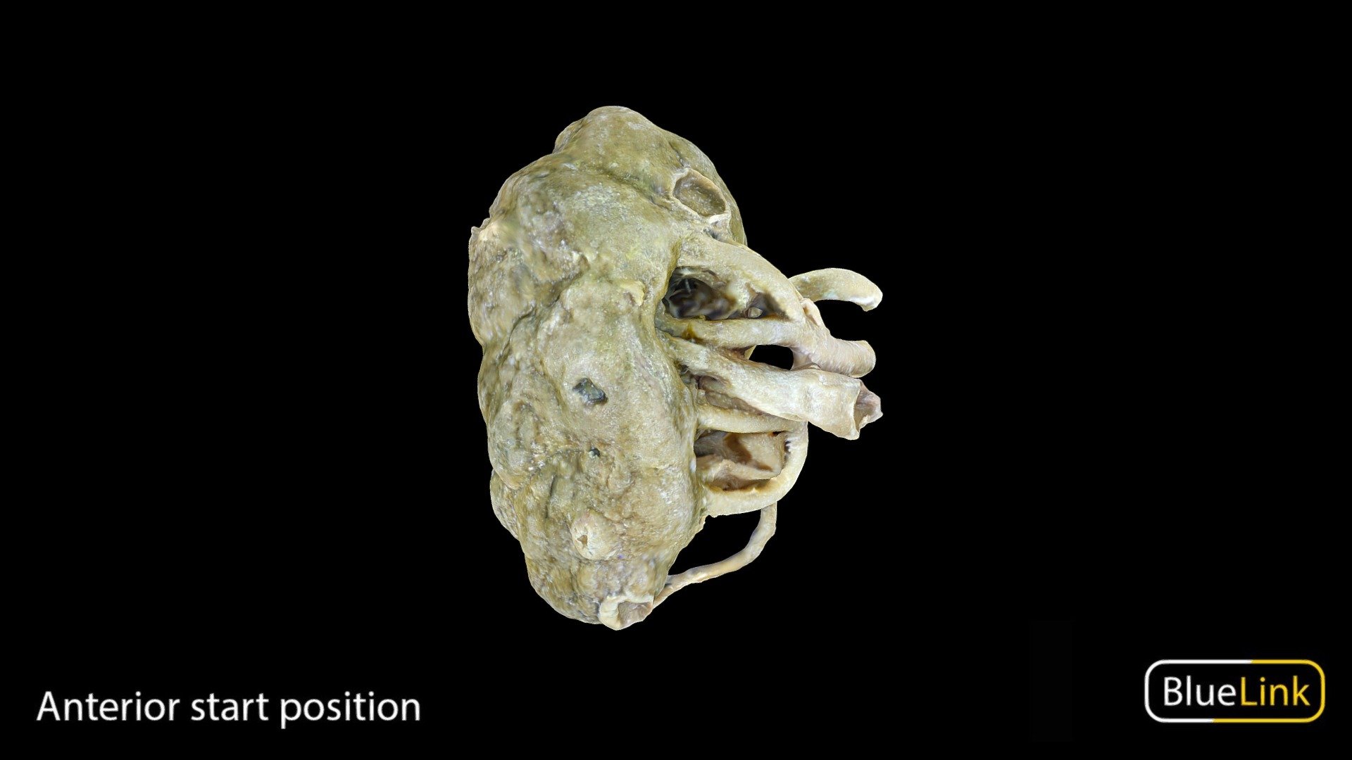 Whole human kidney with apparent pathology

Captured using Photogrammetry

Captured and edited by: Julia Egnaczyk

Copyright 2022 BK Alsup &amp; GM Fox

32501 - A03 - Cystic Kidney - 3D model by Bluelink Anatomy - University of Michigan (@bluelinkanatomy) 3d model