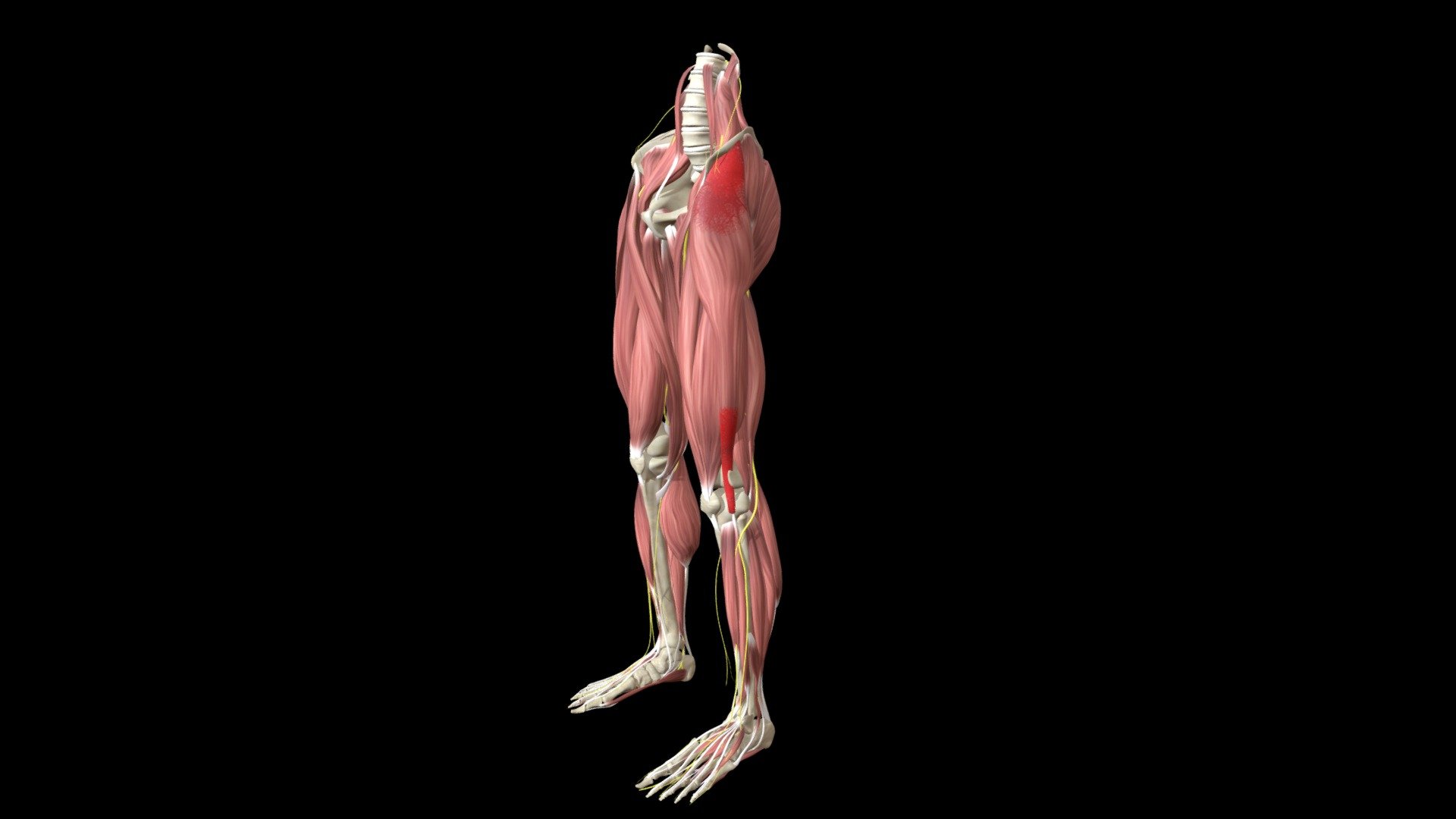 Iliotibial Band Syndrome, Tensor Fascia Latae - 3D model by Znyth 3d model