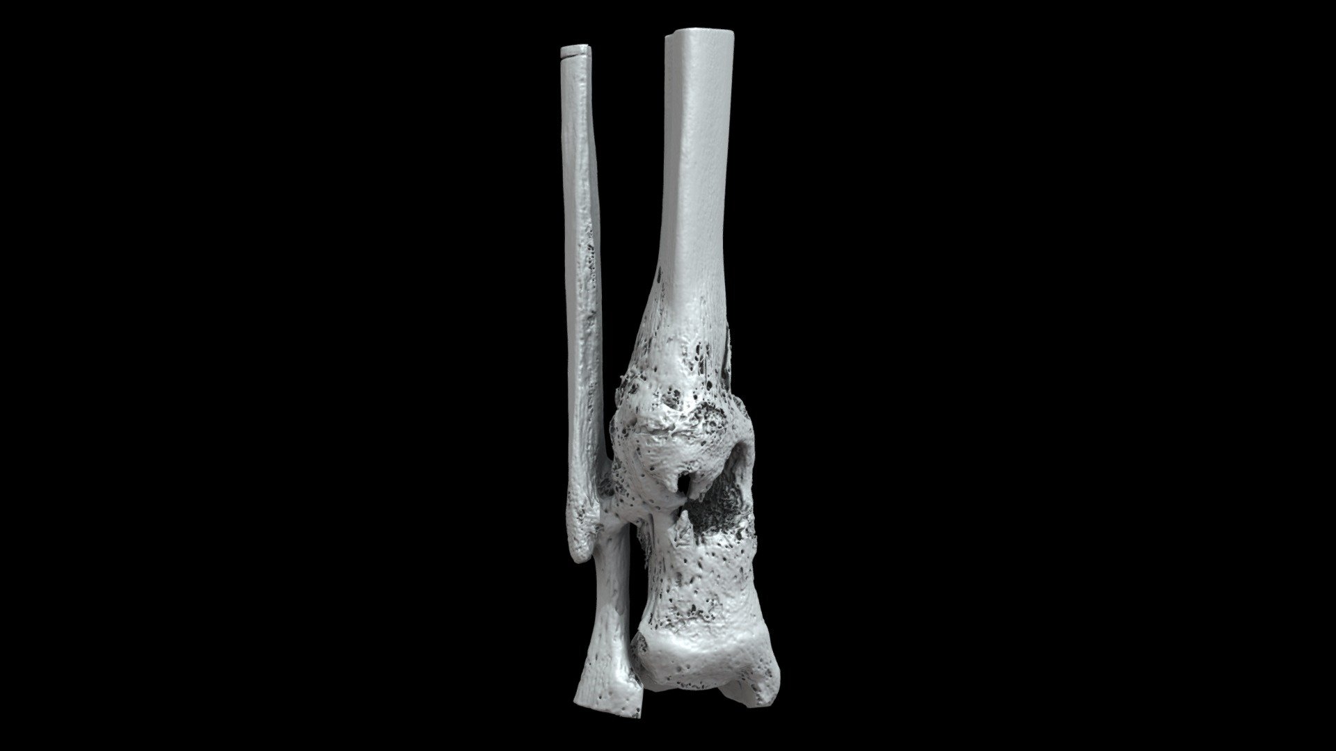 Right distal tibia/fibula with osteomyelitis/healed fracture from the American Civil War; patient William Holmes Co. D 18th Massachusetts, injured at Fredericksburg, VA Dec 13, 1862. Specimen AFIP 1002694 from the National Museum of Health and Medicine (Silver Spring, MD).

Model generated with the Segment Editor in 3D Slicer from a micro-computed tomography scan. 3D models can be downloaded from Morphosource at: https://www.morphosource.org/Detail/SpecimenDetail/Show/specimen_id/31978.

Model generated by Terrie Simmons-Ehrhardt 3d model