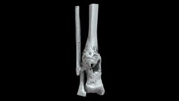 Tibia/Fibula with Osteomyelitis (VCU_3D_5442) tibia, fibula, pathology, osteology, human-anatomy, micro-ct, 3dslicer, paleopathology, osteomyelitis, human-osteology