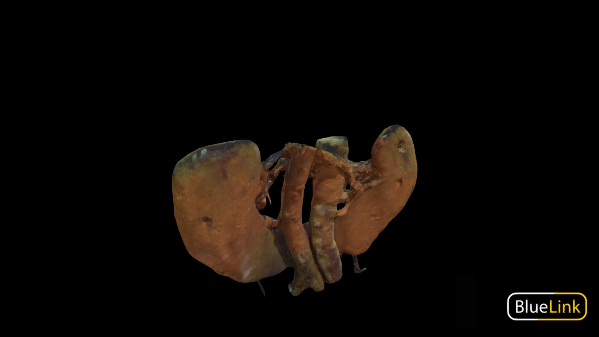 3D scan of a horseshoe kidney

Captured with Einscan Pro

Captured and edited by: Will Gribbin

Copyright2019 BK Alsup &amp; GM Fox

90339-A01 - Horseshoe Kidney - 3D model by Bluelink Anatomy - University of Michigan (@bluelinkanatomy) 3d model