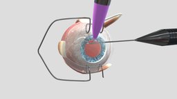 Cataract Surgery Animation eye, surgery, cataract, iol, implantation, capsulorhexis, incisions, aspiration-irrigation, phacoemusification