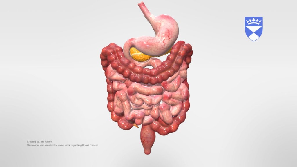 A 3d model sculpted by the MSc Medical Art student Imi Ridley. This work has been used as part of a poster for Ninewells Hospital Dunnde for explaining the staging of bowel cancer 3d model