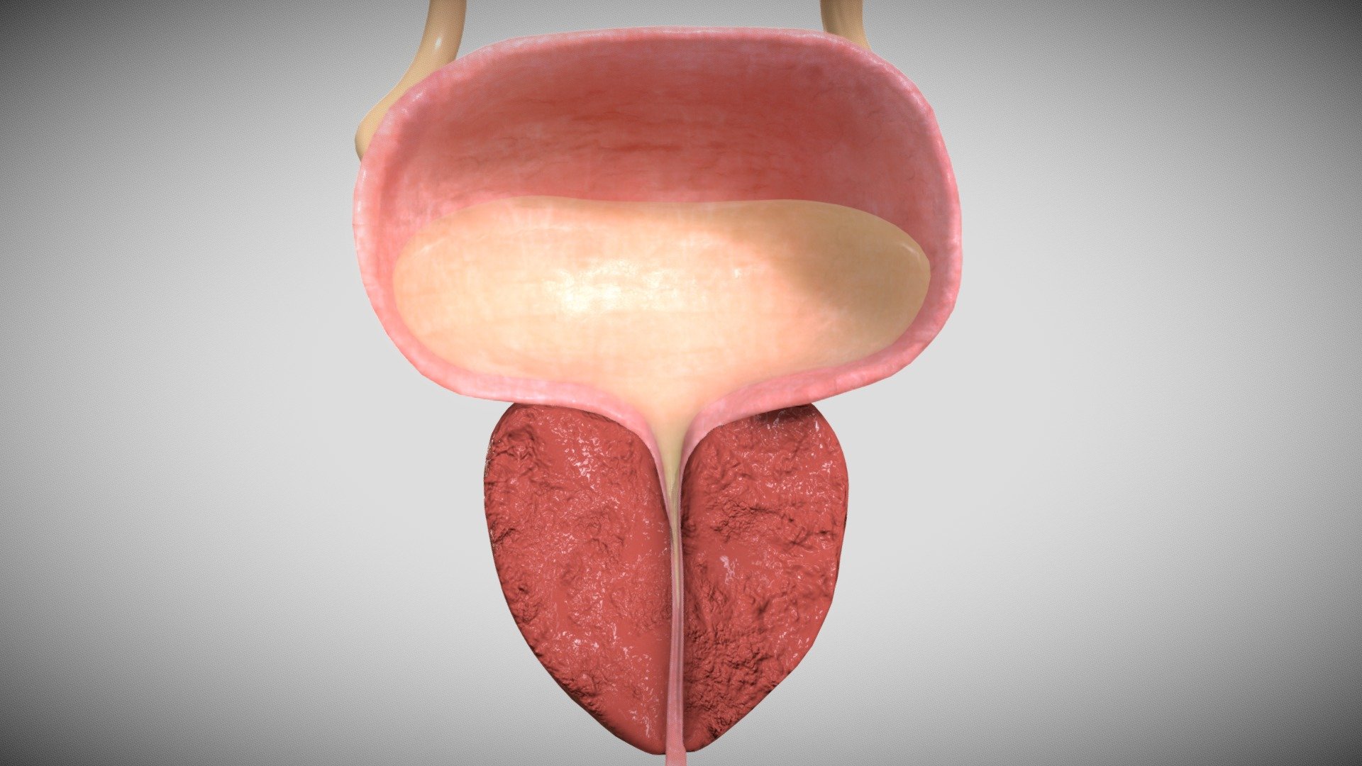 Benign prostatic hyperplasia is a condition in which the prostate gland grows larger. The enlarged prostate may block or slow the passage of urine from the urethra 3d model