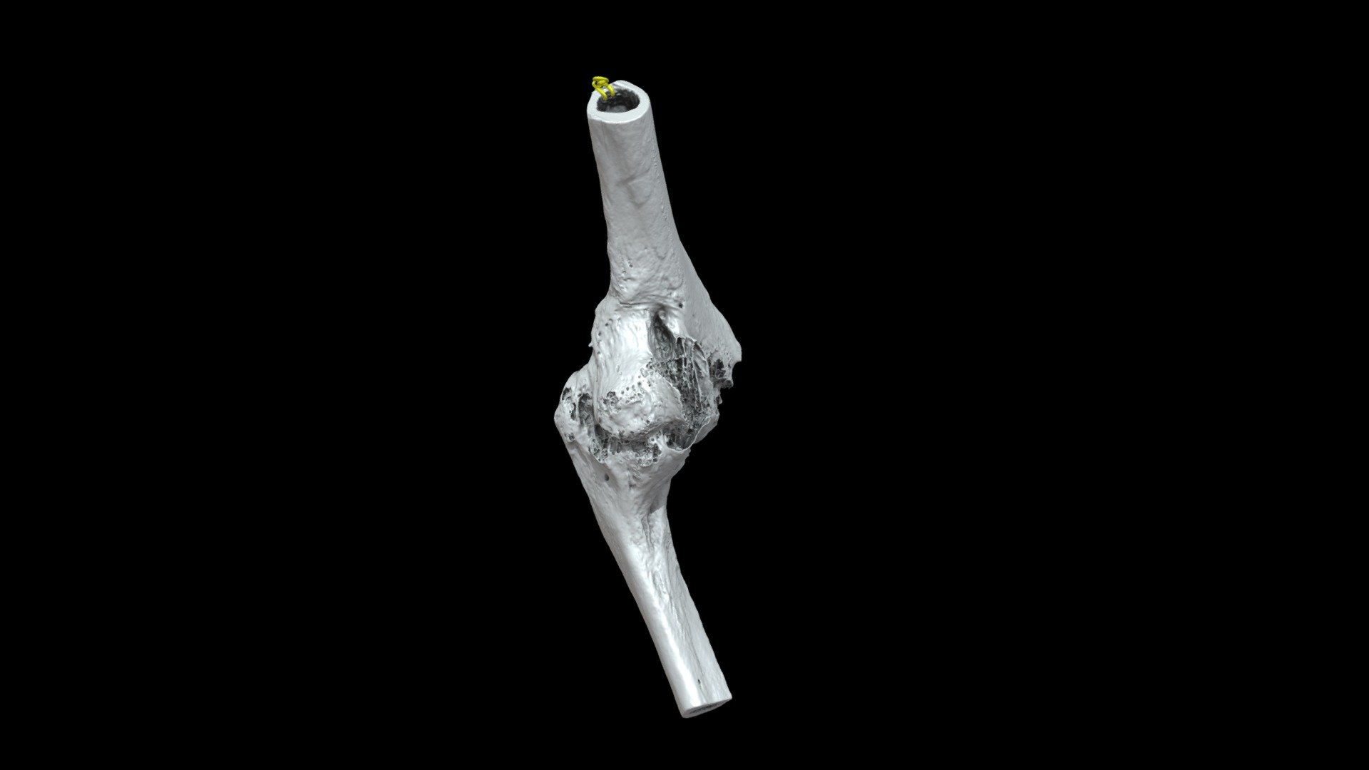 Left elbow (distal humerus and proximal ulna) with traumatic ankylosis from the American Civil War, collected by John Gouley. Specimen AFIP 1002831 from the National Museum of Health and Medicine (Silver Spring, MD).

Model generated with the Segment Editor in 3D Slicer from a micro-computed tomography scan. 3D models can be downloaded from Morphosource at: https://www.morphosource.org/Detail/SpecimenDetail/Show/specimen_id/26332. 

Model generated by Terrie Simmons-Ehrhardt 3d model