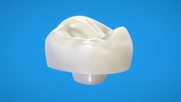 Endocrown 3D tooth, orthodontics, endocrown, 3d, endocrowns