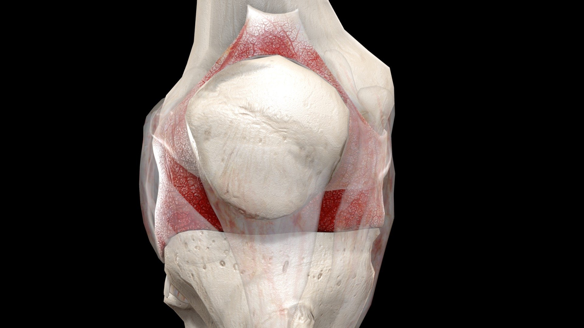 Also known as Hoffa's syndrome or fat pad syndrome, impingement is an injury in which the soft tissue that lies beneath the kneecap becomes pinched at the end of the thigh bone. The condition creates extreme pain below the kneecap and along the sides of the patellar tendon.

©Indiana University Board of Trustees. This project was funded by a grant from the Indiana University School of Medicine Program to Launch those Underrepresented in Medicine toward Success (PLUS) and the Medical Student Education Division of the Indiana University School of Medicine, Department of Family Medicine. 3D imaging created by Luke Parker and Emma Parker 3d model