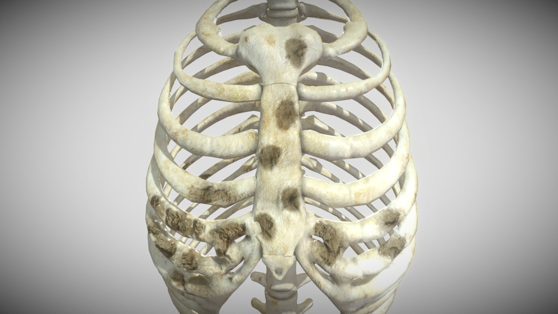-In skeletal tumors, metastatic bone tumors have the most common occurrence [1] and primary bone tumors of chest wall accounts for only 5 - 8 % of all bony tumors.
-Of these approximately 95% occur in ribs and remainder in the sternum.

Reference :-
https://www.fortunejournals.com/articles/expansile-lytic-lesions-of-rib-two-rare-case-reports.html - Lytic Lesions of Rib - Buy Royalty Free 3D model by Ebers 3d model