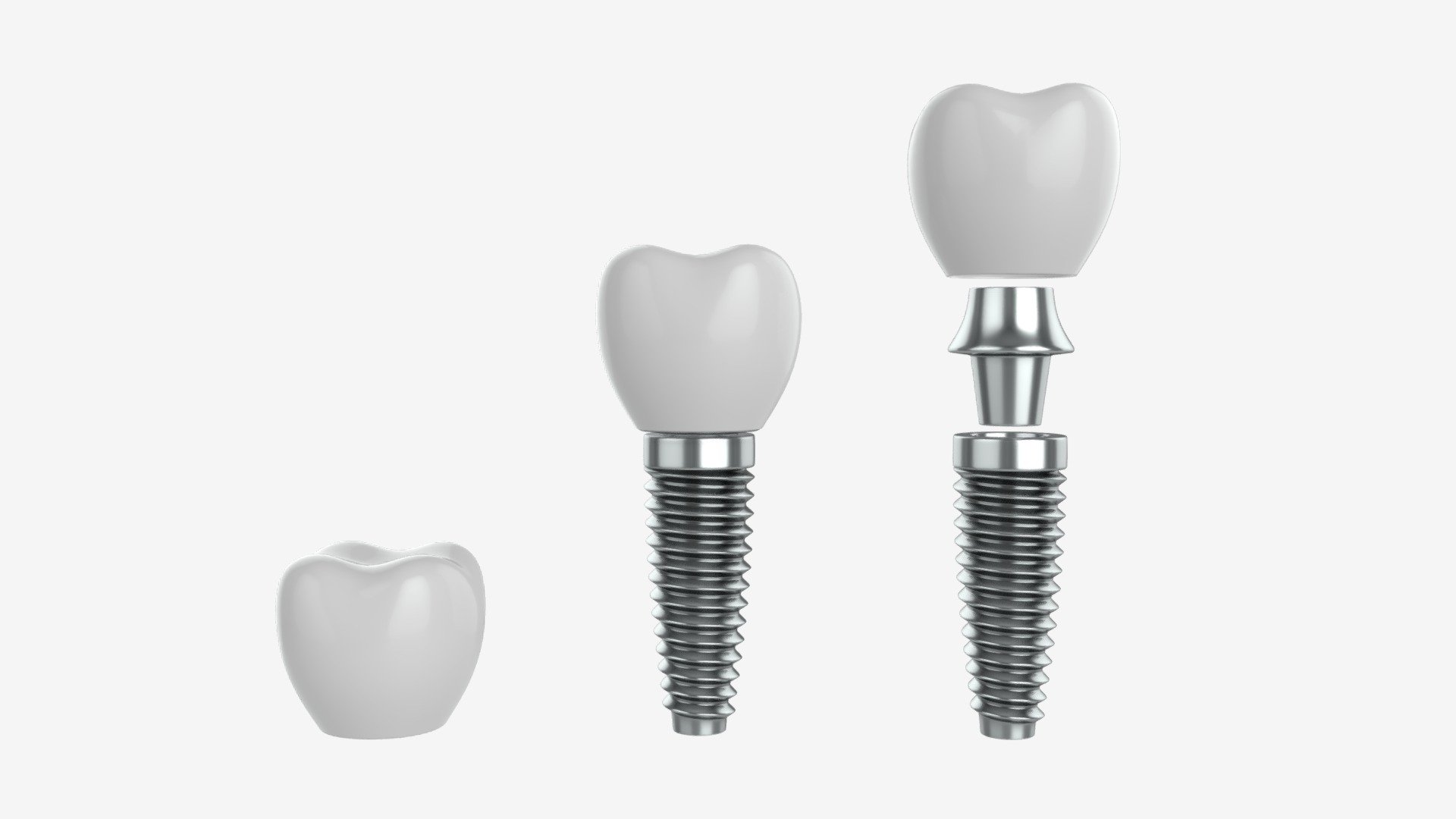 Tooth implant - Buy Royalty Free 3D model by HQ3DMOD (@AivisAstics) 3d model