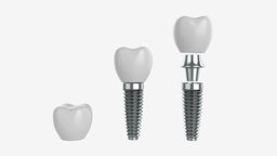 Tooth implant mouth, white, care, dental, dent, crown, jaw, tooth, dentist, surgery, medicine, artificial, implant, root, enamel, implantation, 3d, pbr, medical