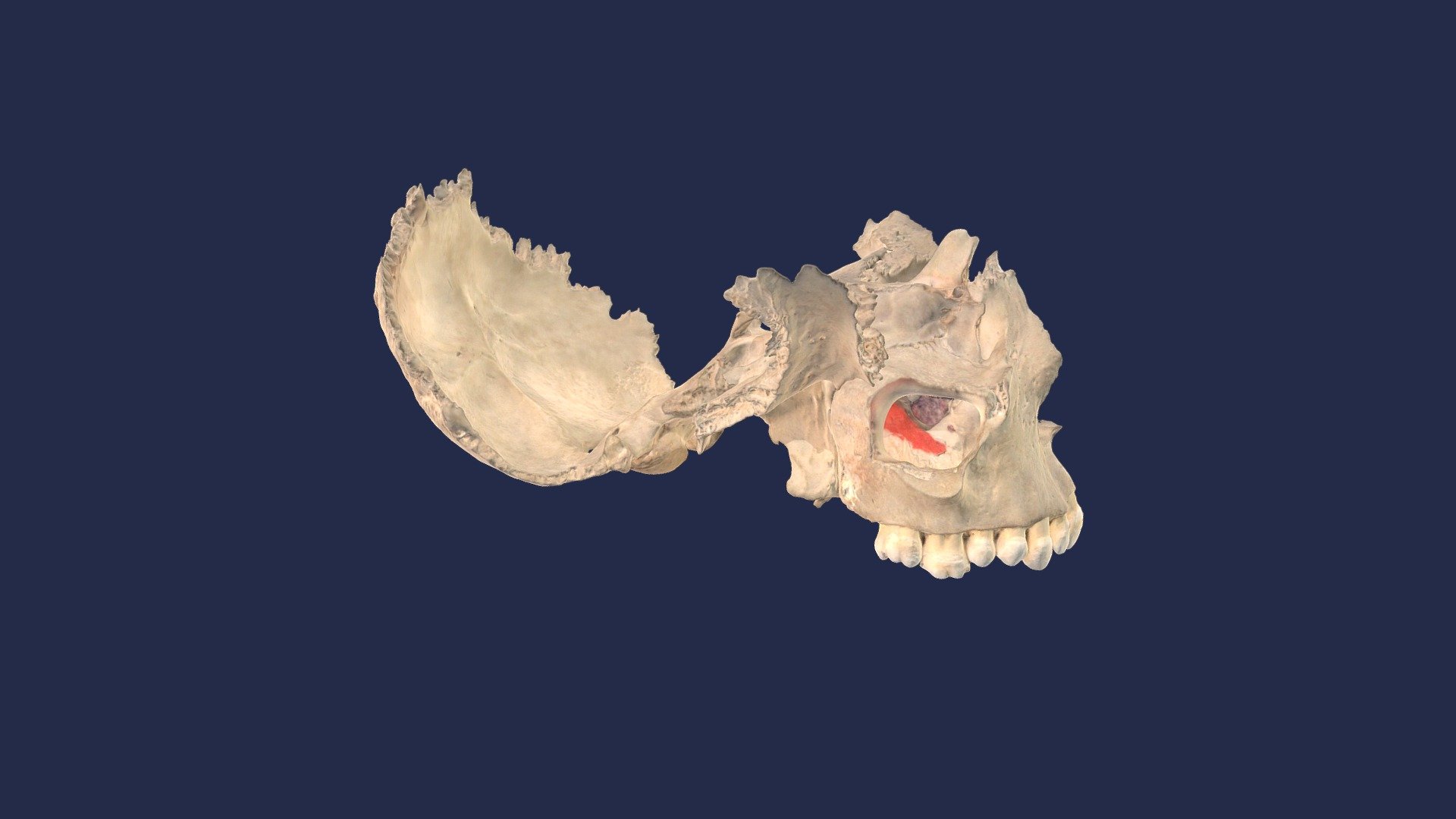Hier ist ein Knochenpräparat eines Teils der Schädelbasis zu sehen (Os occipitale, Os sphenoidale, Os ethmoidale und Os palatinum). Die Bereiche der Nasengänge und des Sinus maxillaris sind aufrund der begrenzten Leistung des Scanners artifiziell verändet (verdickt).

This shows a bone preparation of part of the skull base (Os occipitale, Os sphenoidale, Os ethmoidale and Os palatinum). The areas of the nasal passages and the maxillary sinus are artificially deformed due to the limited capabilities of the scanner.

Institut für Anatomie, Universitätsmedizin Rostock
Institute of Anatomy, Rostock University Medical Center - Schädel (Maxilla, Os Occipitale, Os Sphenoidale) - 3D model by Institute of Anatomy Rostock (@Alexander.Hawlitschka) 3d model