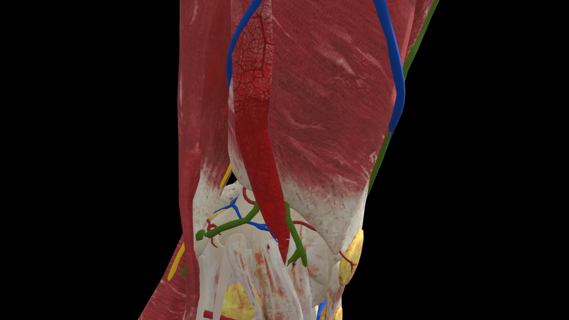 Iliotibial band syndrome is the second most common knee injury caused by inflammation located on the lateral aspect of the knee due to friction between the iliotibial band and the lateral epicondyle of the femur. Pain is felt most commonly on the lateral aspect of the knee and is most intensive at 30 degrees of knee flexion.

This MSK module was funded by: Indiana University School of Medicine. 

All 3D work was completed by: Connections XR - IT band syndrome - 3D model by Znyth 3d model