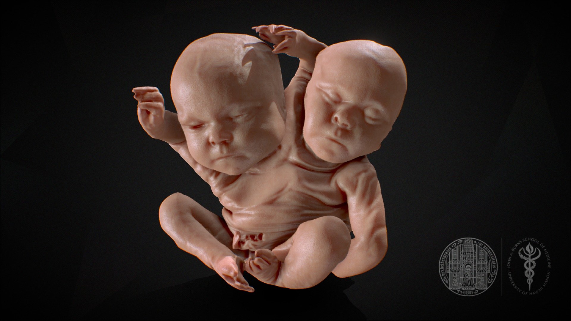 Specimen received by Dr. J. Henle, Dept. Anatomy, Univ of Heidelberg sometime between 1847-1852.

see:https://doi.org/10.1016/j.tria.2022.100171 - Dicephalic Paragus Twins - 3D model by John A Burns School of Medicine (@jabsom) 3d model