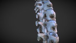 Lytic Lesions of spine body, organ, anatomy, bone, cancer, spine, lesion, pathology, tumor, disease, vertebral-column, ebers, human, bones, metastatic, lysis, spine_cord