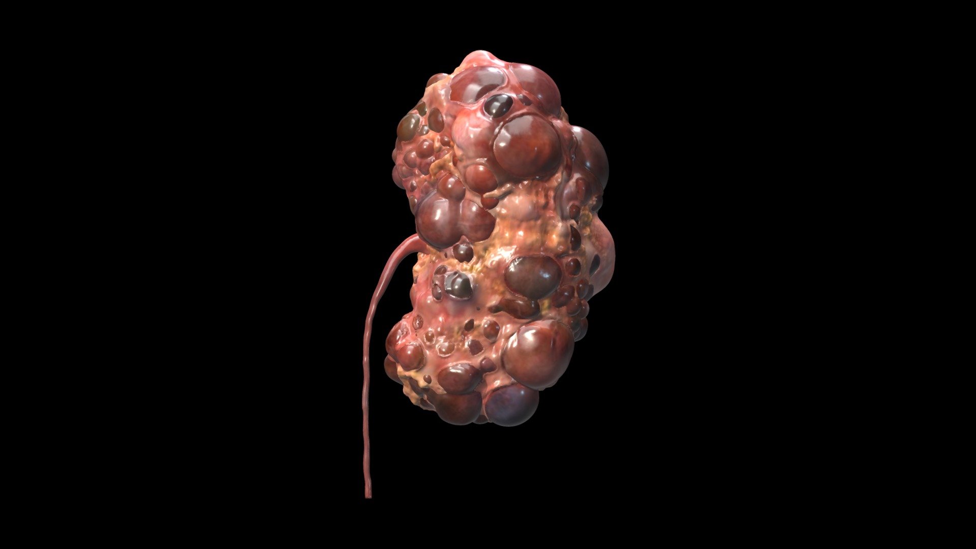Polycystic Kidney - 3D model by elvire 3d model