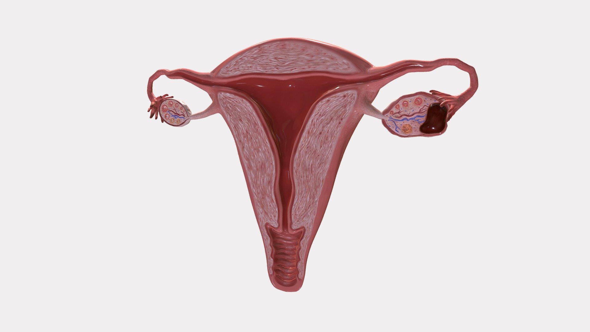 Uterus Cross Section with Endometrioma - Buy Royalty Free 3D model by Aimee Hutchinson (@Aimeehutchinson) 3d model