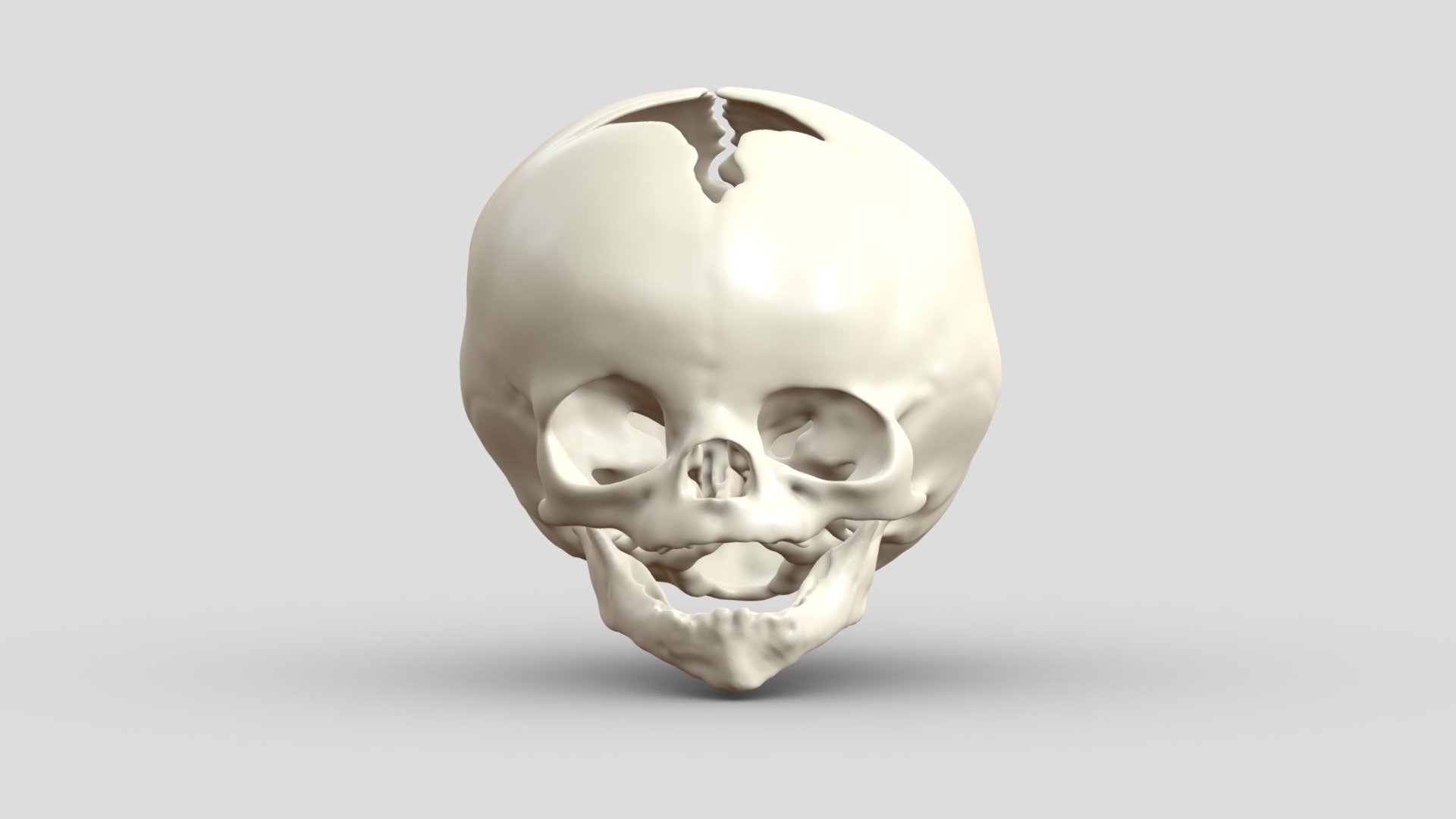 An infant cranium and mandible (6 months old) with left frontosphenoidal craniosynostosis. Small gaps between cranial bones were filled to make it easier to 3D print. The mandible was also solidified to make 3D printing easier (unerupted teeth are not visible)&ndash;central mandibular incisors are erupted. You can also cut the cranium before 3D printing to have access to the endocranial anatomy.

I segmented this from a computed tomography scan from Embodi3D.

Download includes beige PLY of the cranium and mandible combined. The additional file contains the separated STL models for 3D printing 3d model
