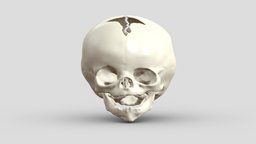Left Frontosphenoidal Craniosynostosis anatomy, cranium, mandible, pathology, osteology, human-anatomy, biomedical, skull, medical, human-osteology, craniosynostosis, noai